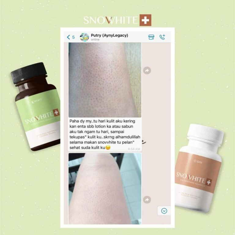 snovvhite testimoni snovvhite review snovvhite supplement kkm snovvhite supplement testimoni snovvhite whitening booster